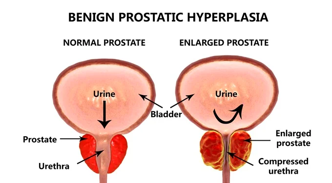 Prostatitis is a very common condition and frequently results in a condition called benign prostatic hyperplasia (BPH).