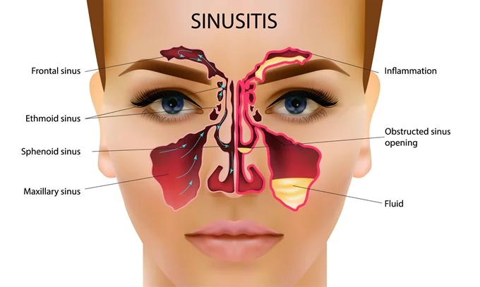 Sinusitis can cause eye swelling, discharge, vision changes and dry eyes.