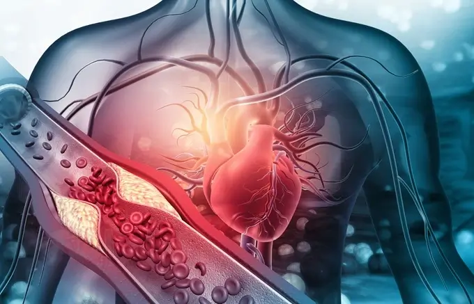 Severe complications from high cholesterol include heart attack and stroke.