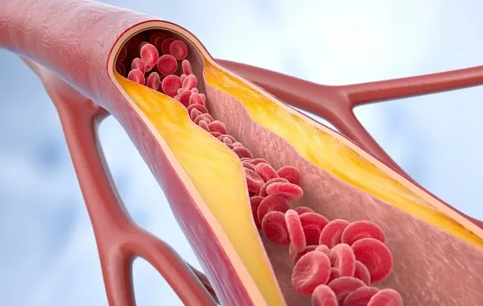 Arterial plaque is a build-up of fatty material and cholesterol within the walls of an artery